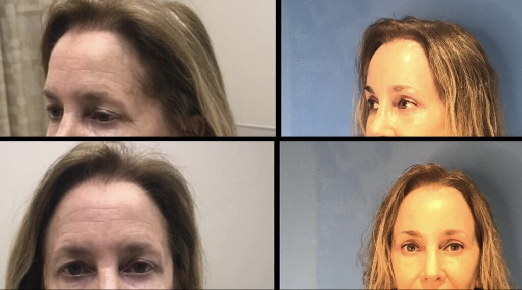 Blepharoplasty (Eyelid) 2 IMG 3166