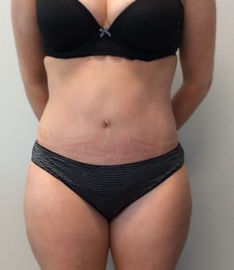 abdominoplasty-tummy-tuck-after