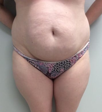abdominoplasty-tummy-tuck-before