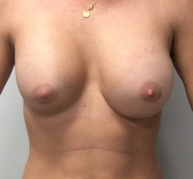 before-breast-en-bloc-removal2
