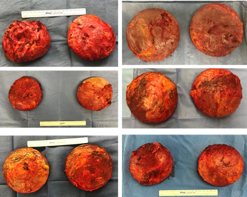 breast-removalen-bloc-example-images