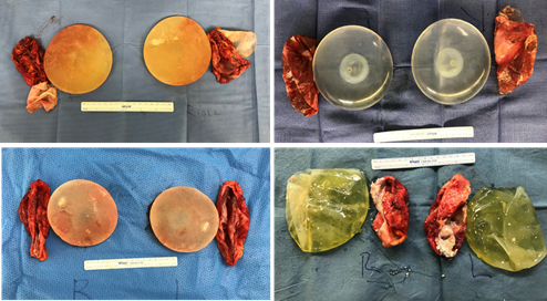 example impant removals with capsules