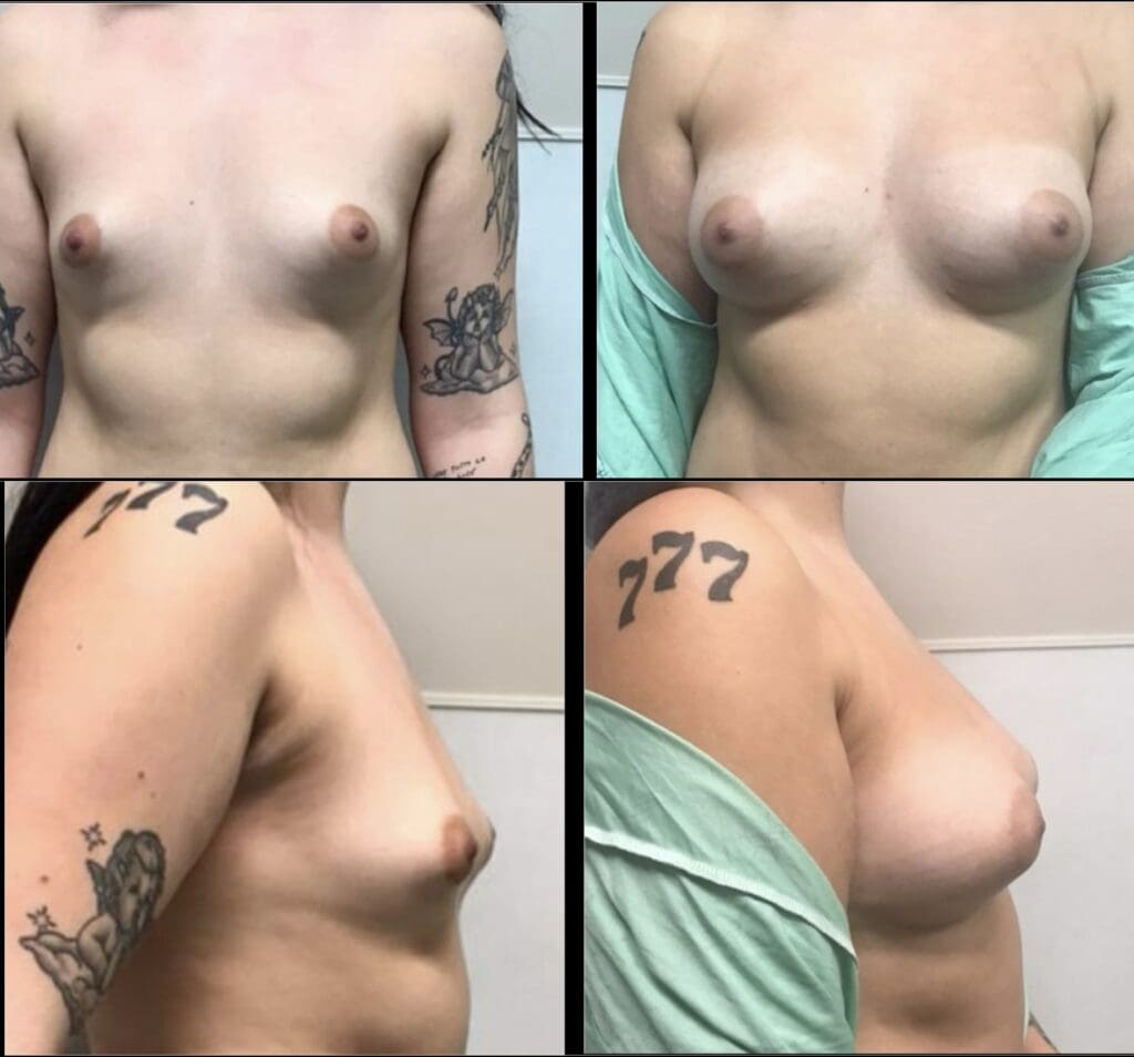 fat-transfer-to-breast2