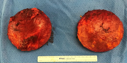 image-of-implant-removal-full-capsulectomy