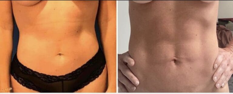 liposuction-before-after-dr-stanwix