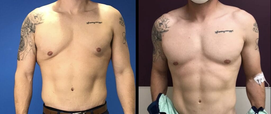 gynecomastia before/after