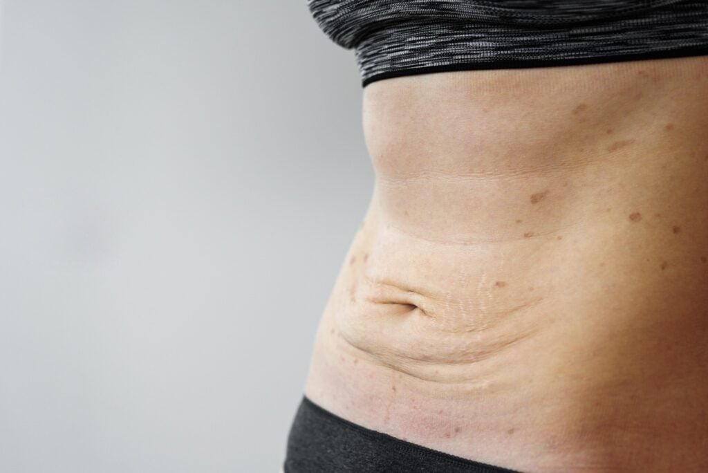 The Truth About Tummy Tuck Complications 3 Hematoma Symptoms and Bruising After Abdominoplasty – Central Virginia Recovery Tips