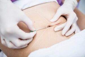 Aesthetic surgery, mesothreads, lifting