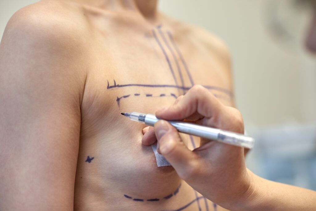 Fat Transfer Breast Augmentation Procedure Overview – Richmond, VA