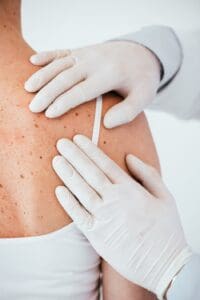 Cosmetic Benefits of Removing Benign Skin Lesions 1 cosmetic removing Benign Skin Lesions by Dr. Stanwix in Richmond VA