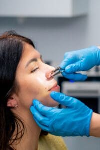 Before and after rhinoplasty results by Dr Stanwix Plastic Surgery