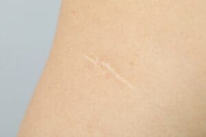 Richmond VA patient discussing scar revision surgery during a consultation with Dr Stanwix Clinic