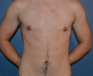 FTM chest reconstruction before and after by Dr. Stanwix