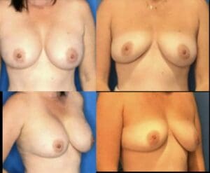 Before and after breast implant removal with en bloc capsulectomy at Stanwix Plastic Surgery in Richmond