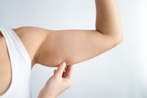Loose upper arm skin known as bat wings before non-surgical treatment at Stanwix Plastic Surgery