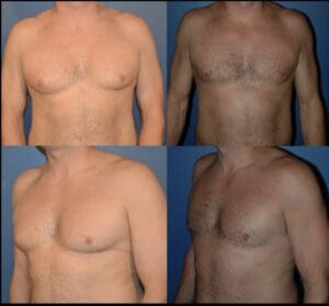 Before and After Gynecomastia Surgery Result in Richmond-Dr Stanwix 