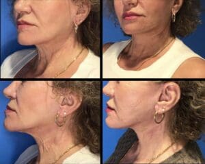 Neck Lift - before-after Richmond