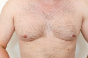 Gynecomastia consultation at Dr Stanwix Surgery in Richmond addressing hormonal imbalance