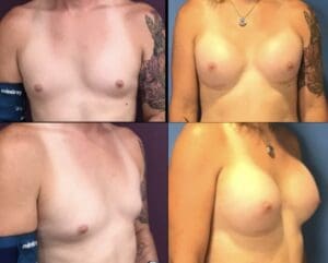 after-before photos of MTF Surgery performed by Dr Stanwix Clinic