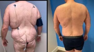 after-before-Liposuction-mens