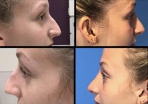 Female Rhinoplasty-before-after
